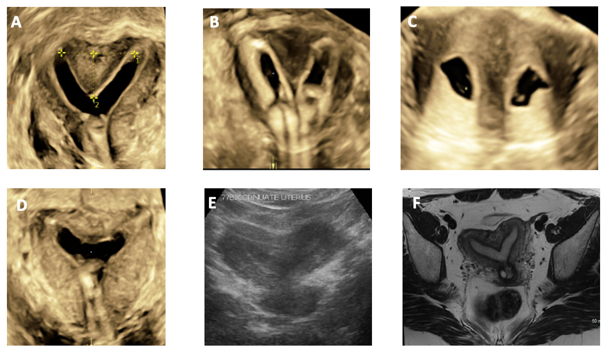 Figure 18: (A) 3D ultrasound coronal view of partial septate uterus, (B) 3D ultrasound coronal view of a complete septate ute