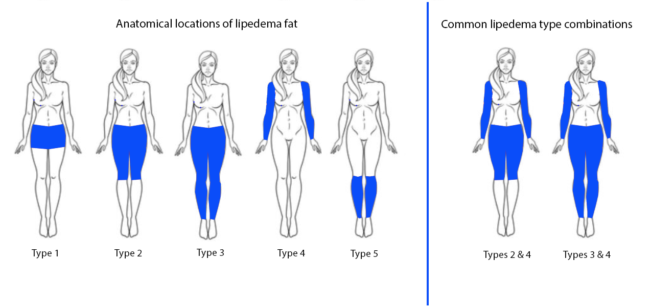 <p>Lipedema Types</p>