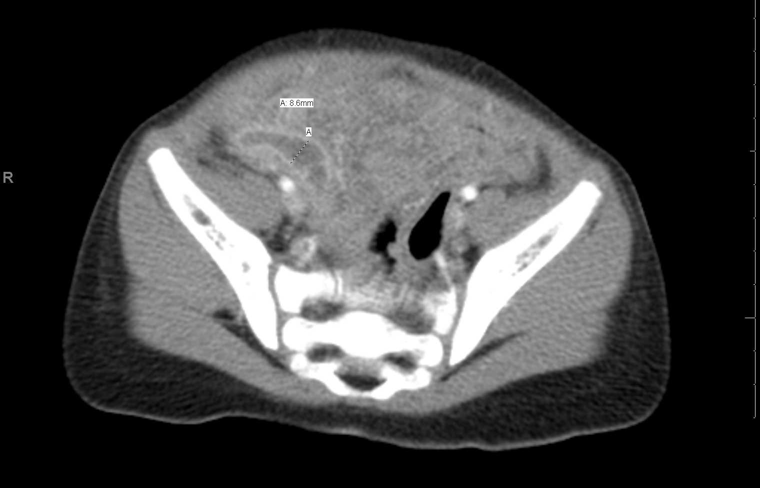 <p>Abdomen CT, Acute Appendicitis</p>