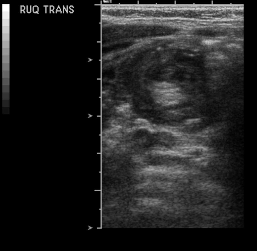 <p>Abdomen Ultrasound, Intussuception Appendicolith</p>