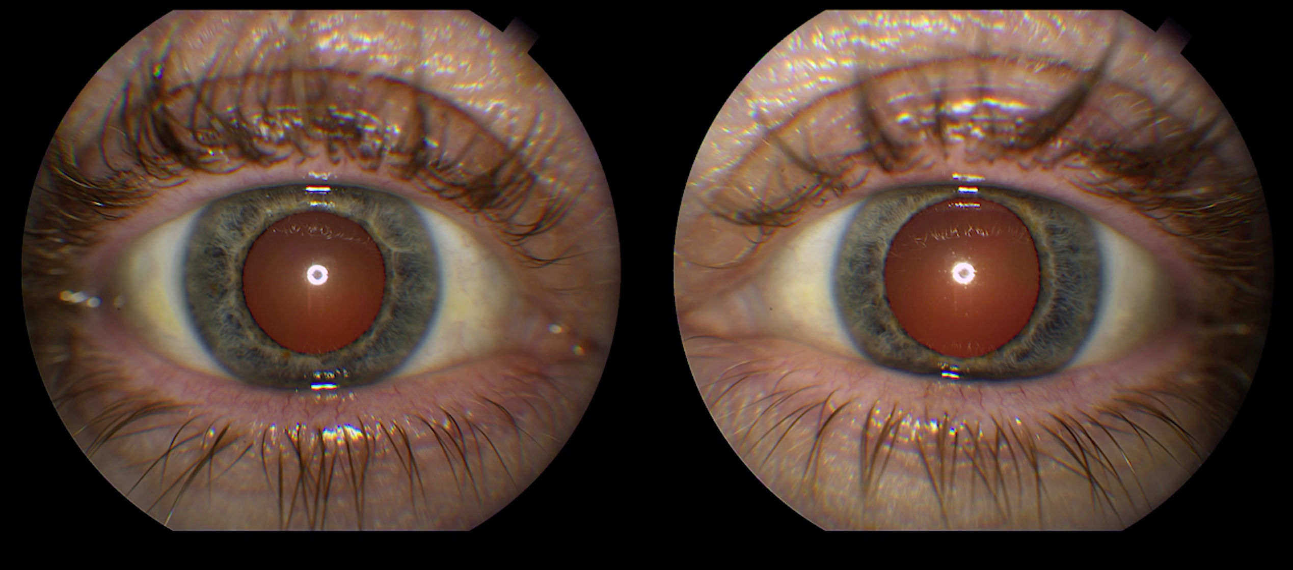 The red reflex: a normal red reflex in each eye with equal clarity and brightness