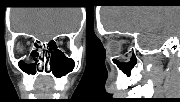 <p>Orbital Floor Fracture Computed Tomography