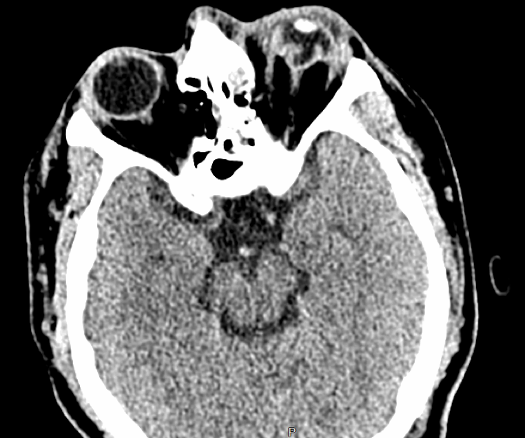 Axial computed tomography of the orbits demonstrating an abnormal posterior globe contour and loss of globe volume, consistent with a posterior globe rupture