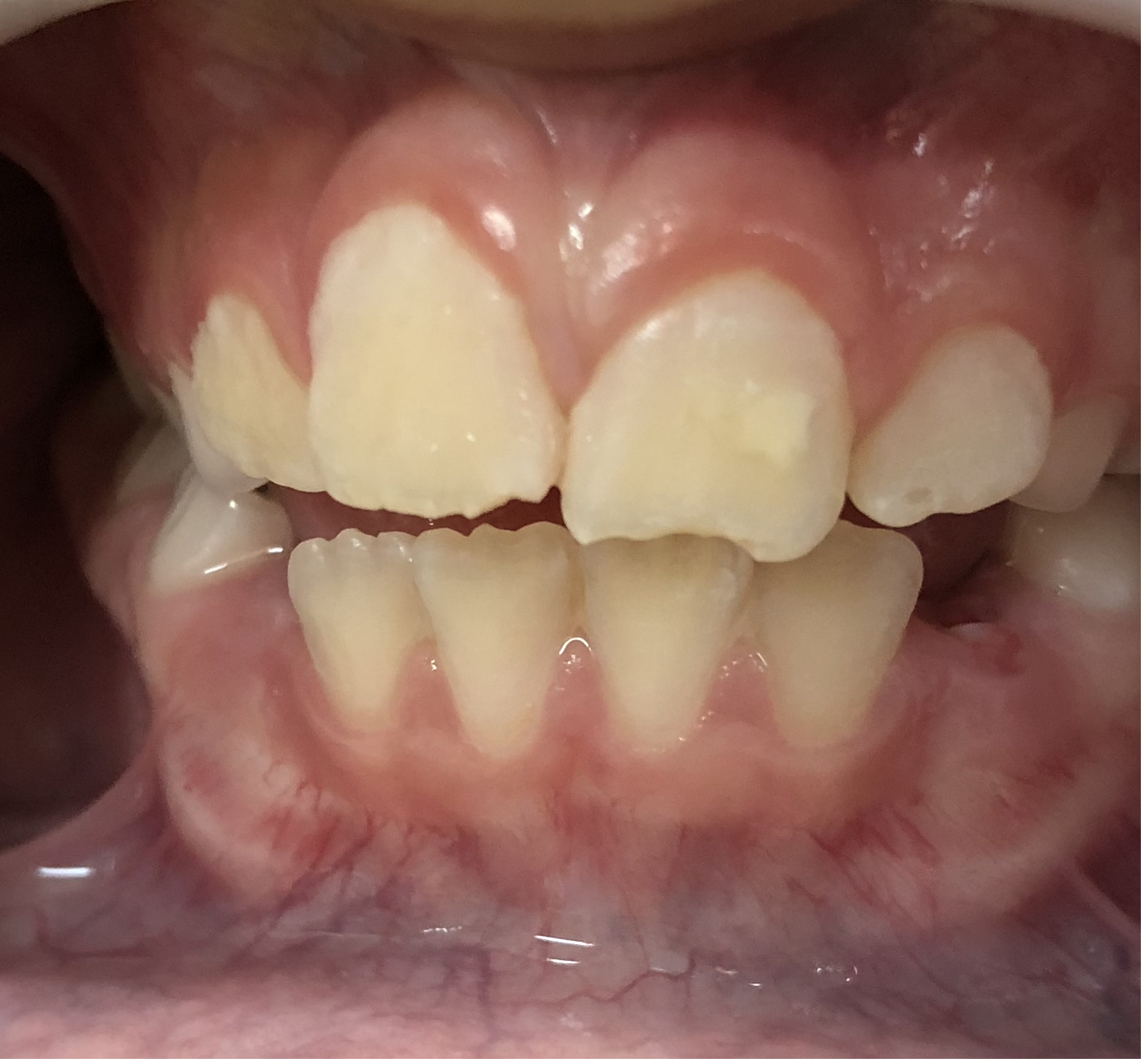 Molar-Incisor Hypomineralization (MIH)