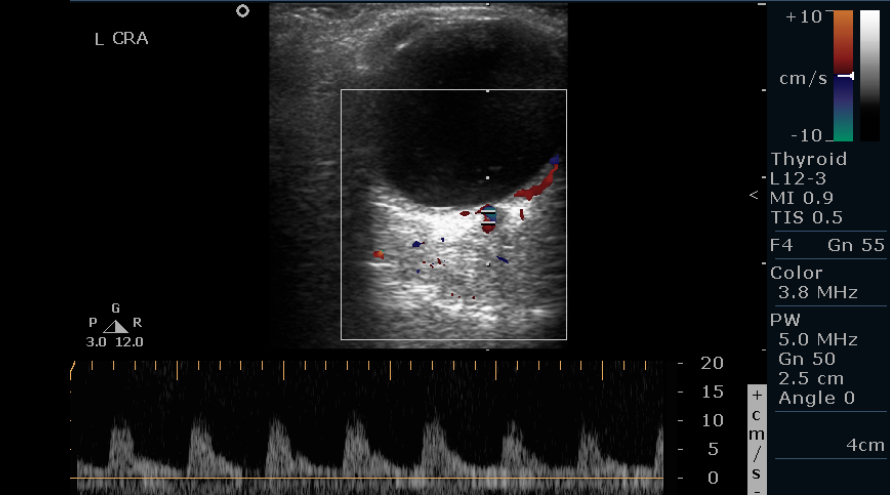 <p>Normal Central Retinal Artery Doppler of the Left Eye