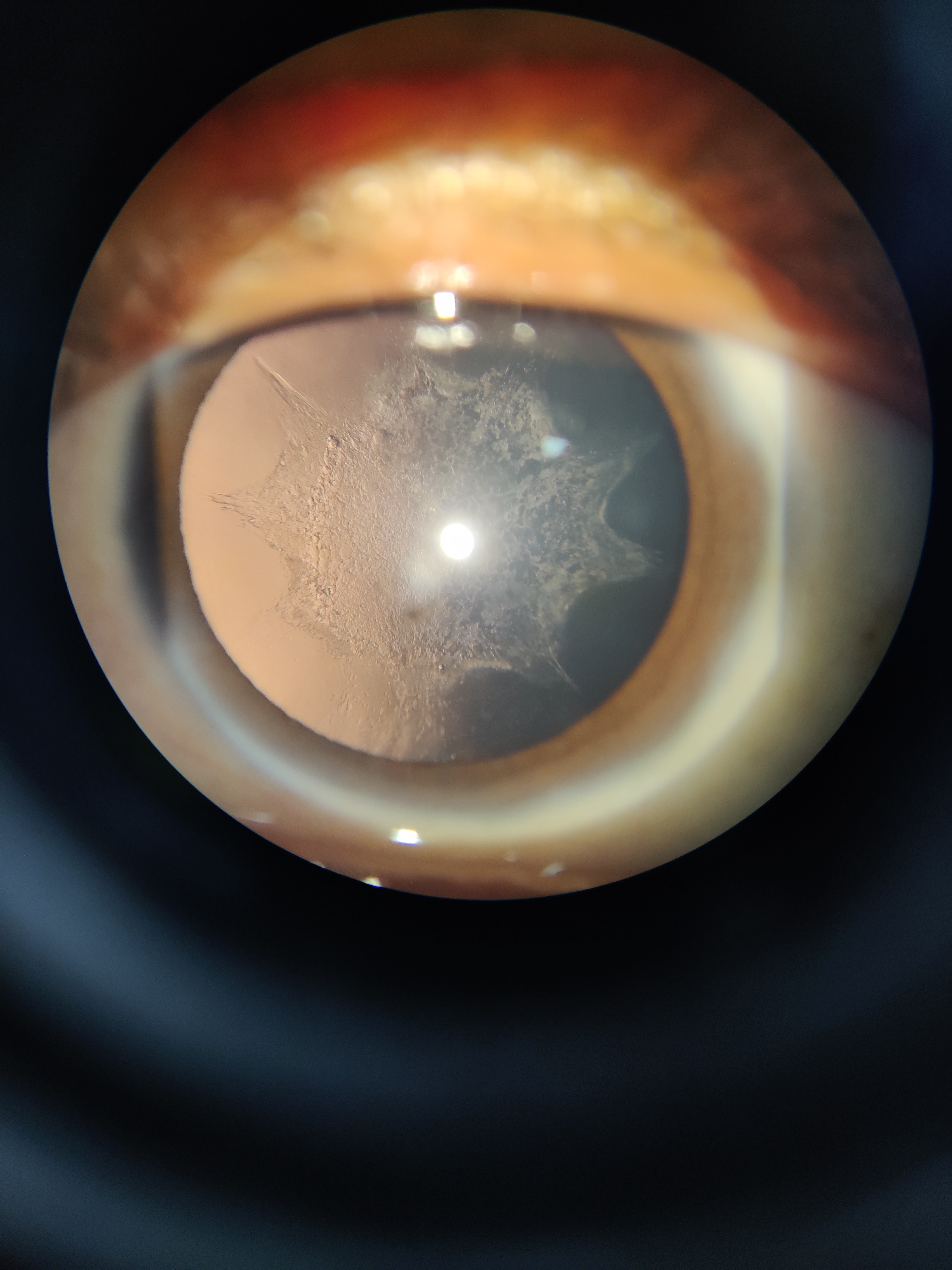 Slit lamp examination under retroillumination of a patient with complicated cataract, reveals diffuse Posterior subcapsular cataract with typical BREADCRUMB appearance