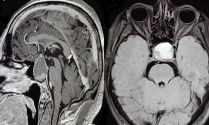 <p>Pituitary Apoplexy, Sagittal and Axial Views