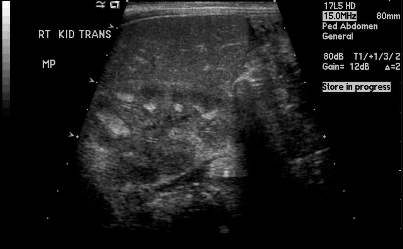 <p>Renal Ultrasound, Medullary Nephrocalcinosis</p>