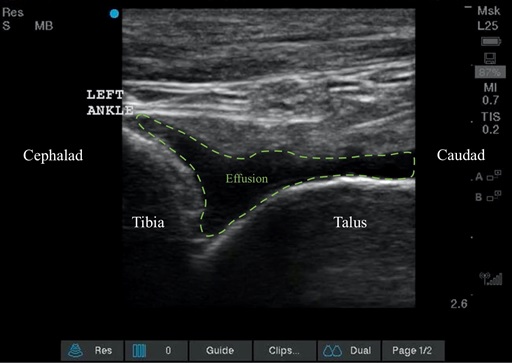 Ultrasound image of an ankle effusion prior to arthrocentesis