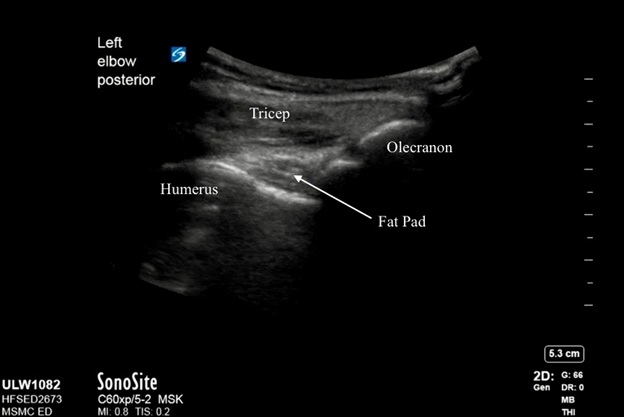 Ultrasound image demonstrating normal anatomy of the elbow with the probe marker in a cephalad and longitudinal position along the posterior aspect of the elbow