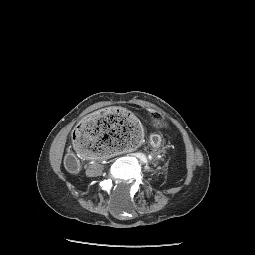 <p>Abdomen CT,&nbsp;Myelomenigocele</p>