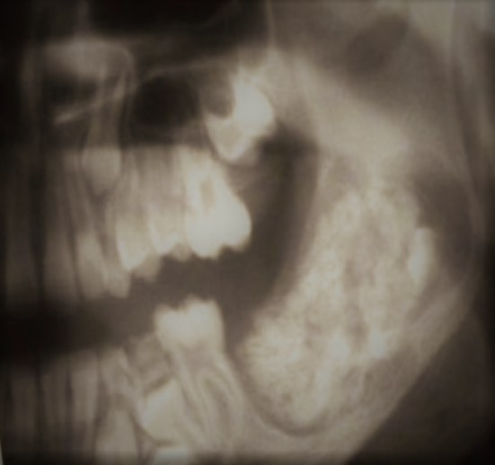 Fig. 5: OPG of complex odontoma