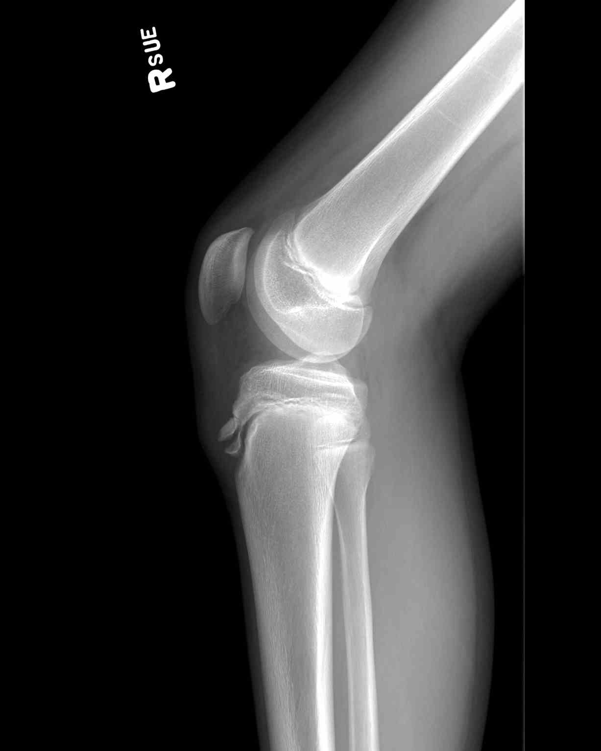 <p>Lateral Knee Radiograph, Osgood-Schlatter Disease</p>