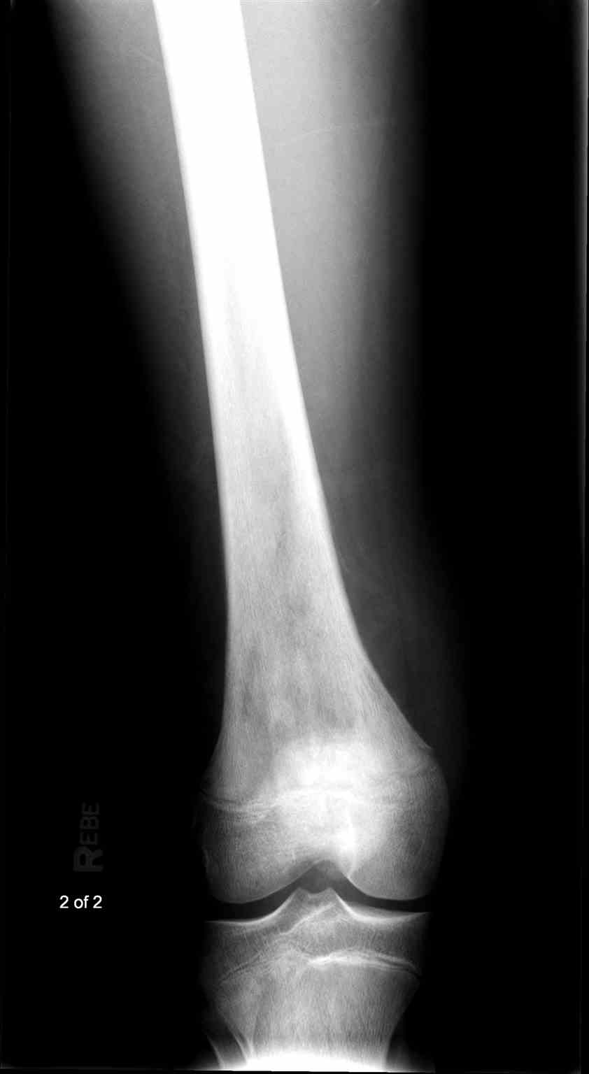 <p>Femur Radiograph, Osteosarcoma</p>