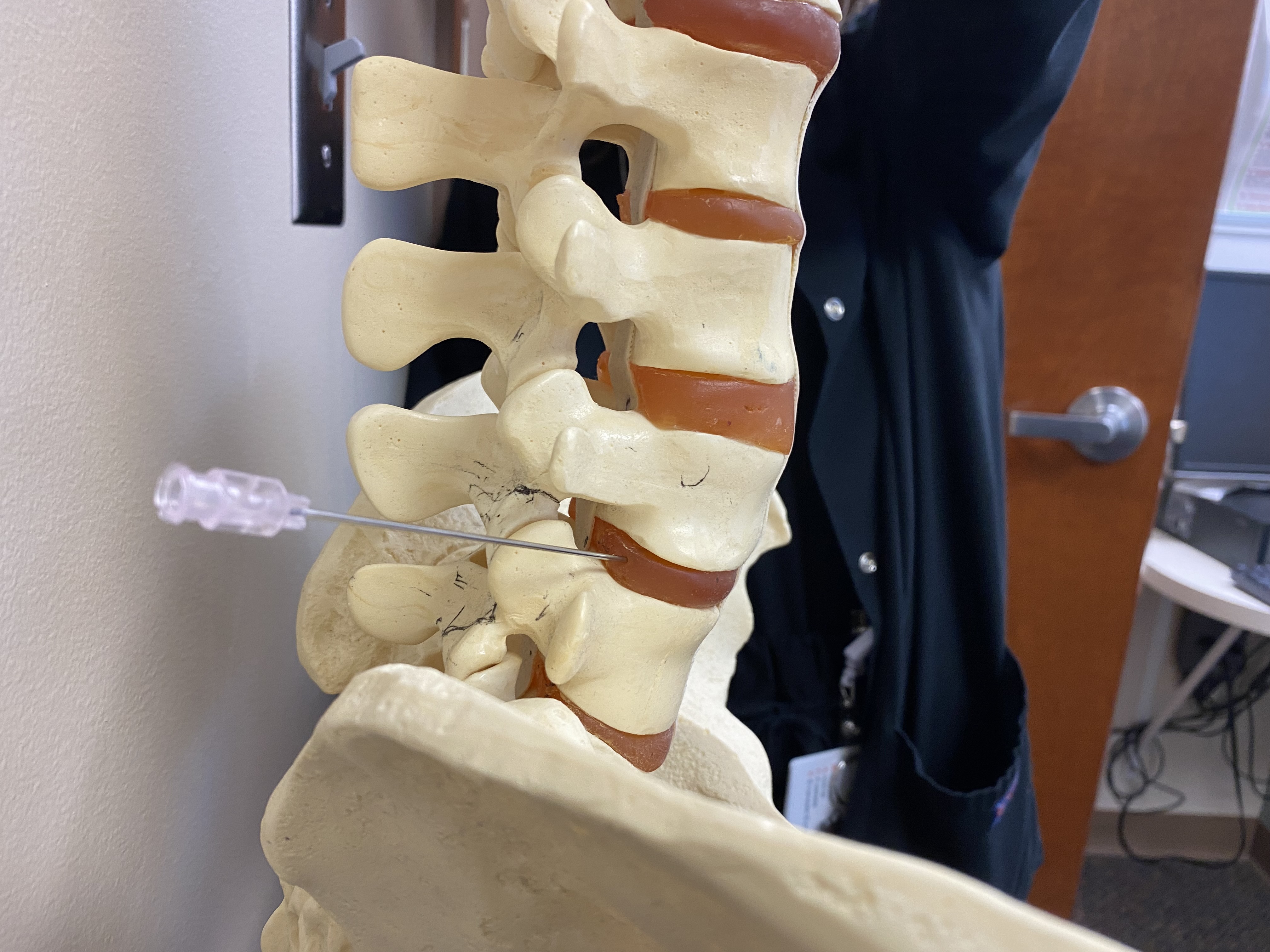 Needle entry into disc spaces above L5/S1, here shown L4/5, is usually more straightforward due to the more self allowed placement from the iliac crest