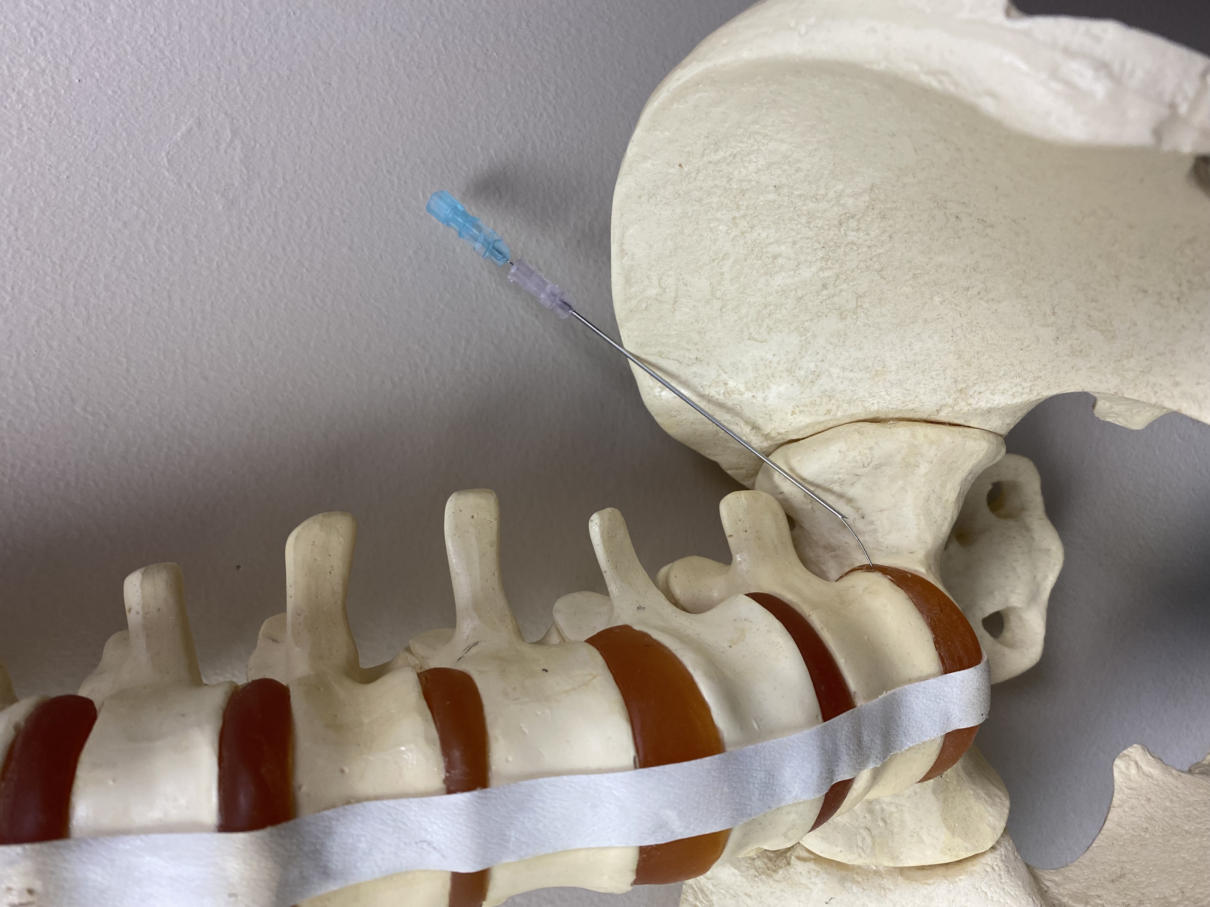 Anterior view of L5/S1 entry demonstrating how this technique may be required due to the placement of the iliac crest