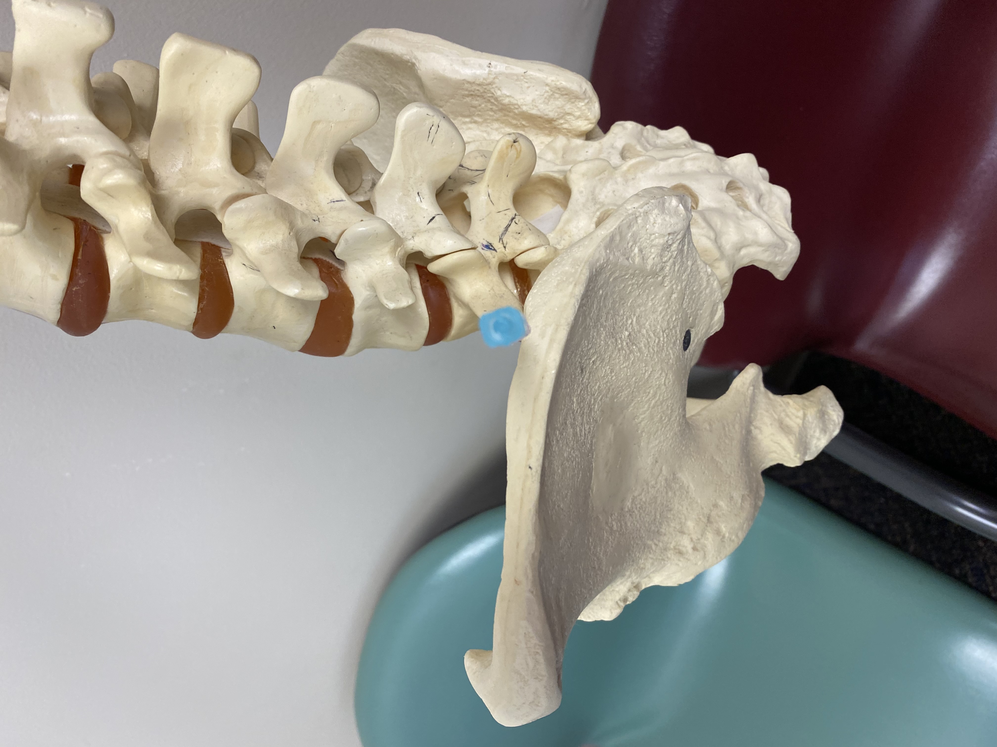 The iliac crest may require the initial entry to be high, above the inferior endplate of the L5 vertebra and/or too far anter