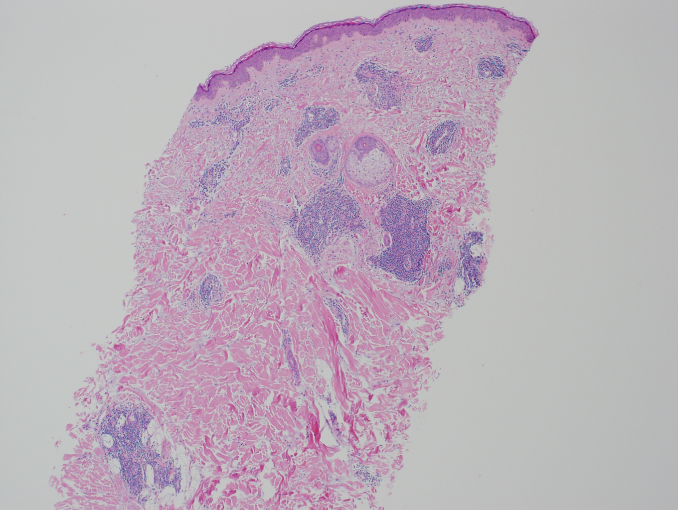 4X histopathology of tumid lupus erythematosus