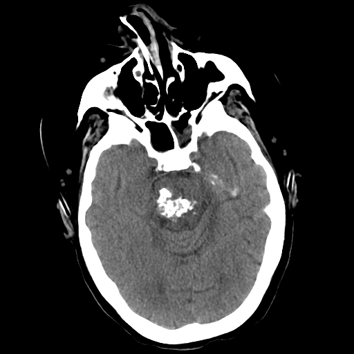 <p>Head CT, Pons Cavernoma</p>