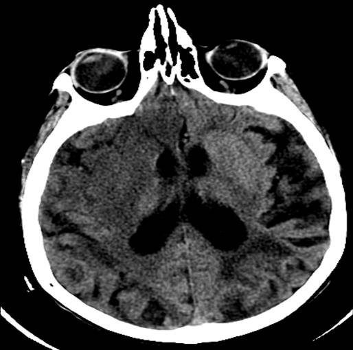 <p>Head CT,&nbsp;Right Middle Cerebral Artery (MCA) Stroke</p>