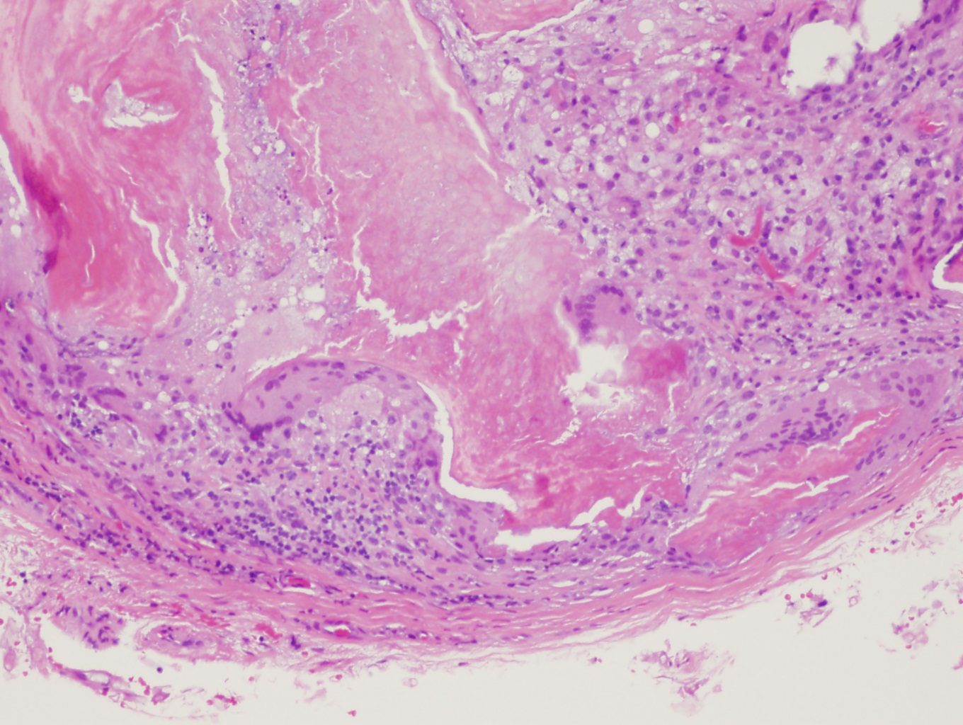 <p>Pilomatrixoma Histopathology, High Magnification
