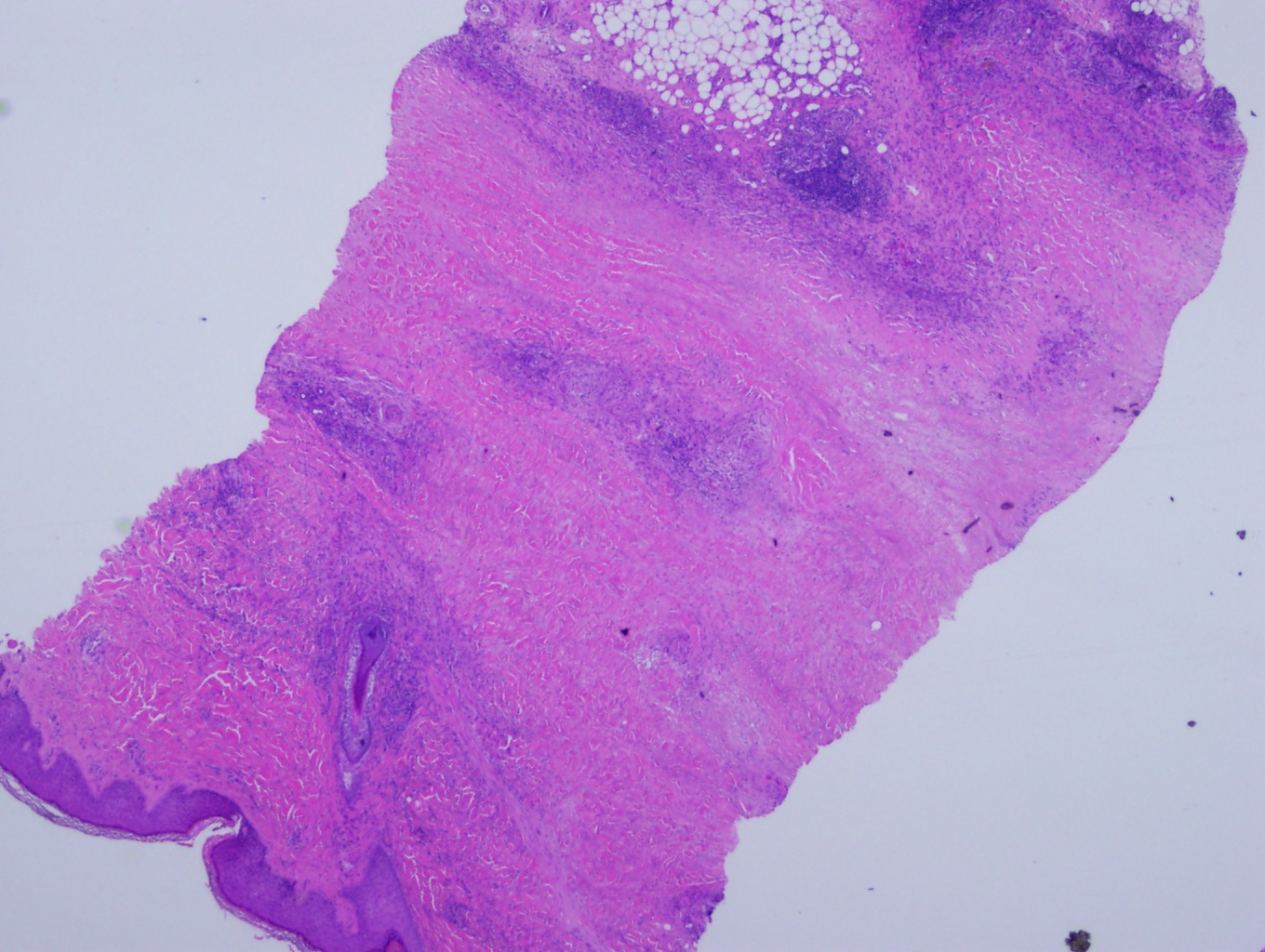 <p>Low-Power Histological Findings of Necrobiosis Lipoidica