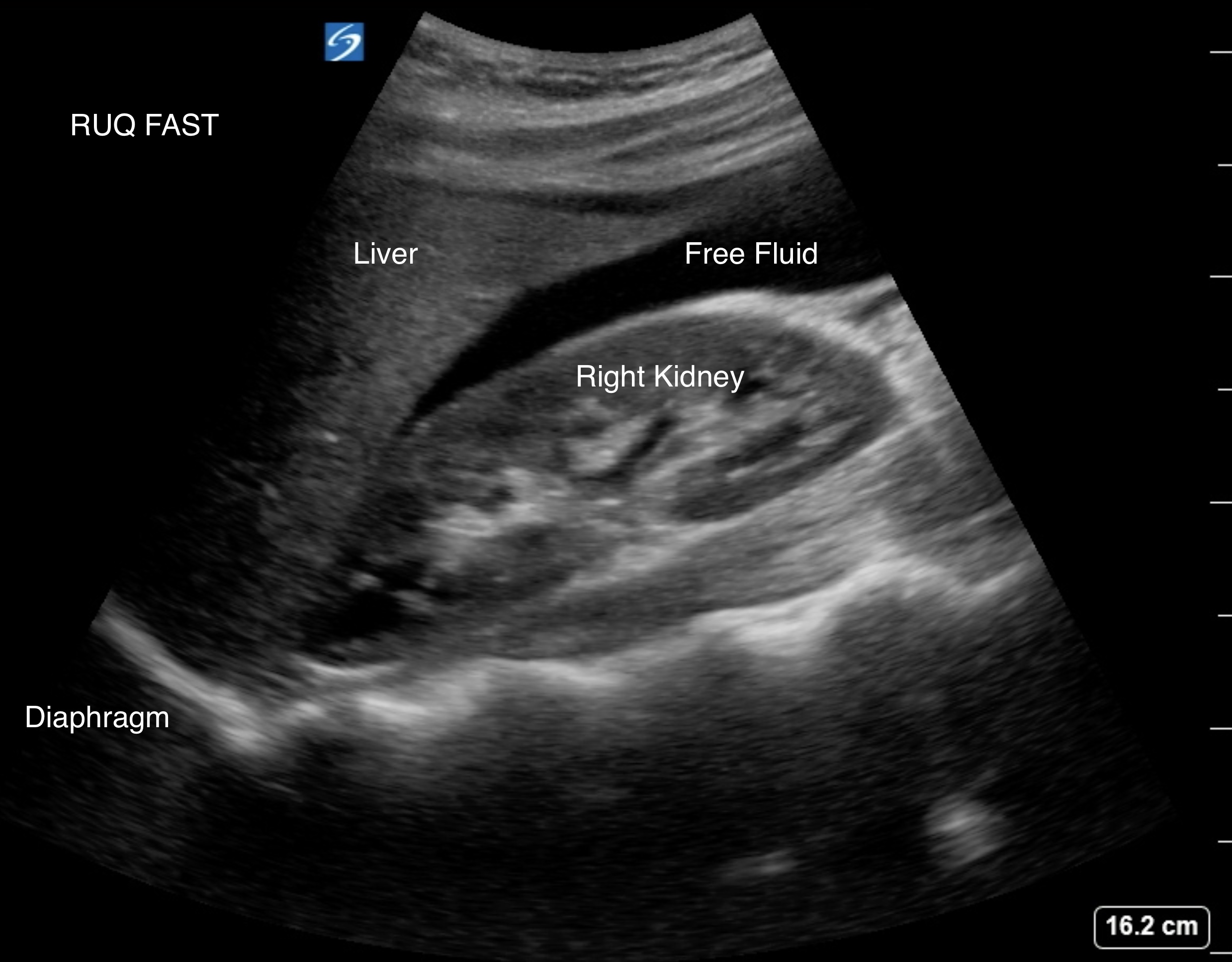 <p>Ectopic Pregnancy