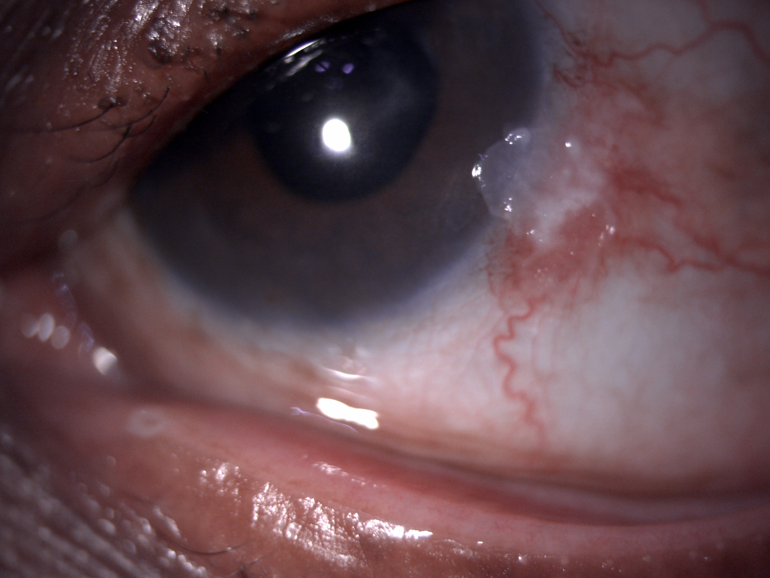 Slit lamp image of the patient depicting nasal whitish gelatinous conjunctivocorneal elevated plaque suggestive of ocular sur