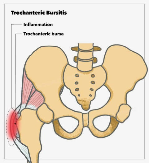 Trochanteric Bursitis