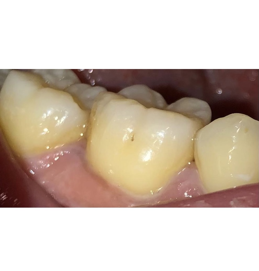 Inactive initial lesion in the pit of 46.