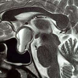 <p>Pituitary Apoplexy, Sagittal View. The pituitary gland is enlarged and has a hyperintense anterior region.</p>