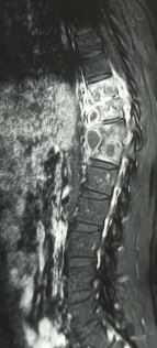 Pott's spine