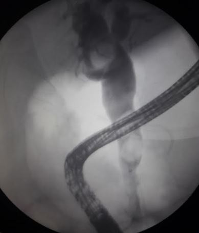 ERCP in CBD stones