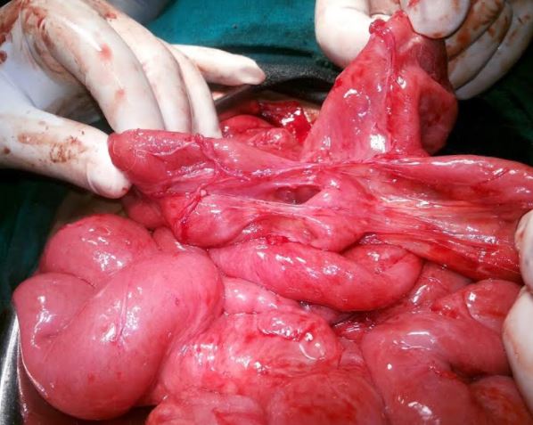 adhesive intestinal obstruction