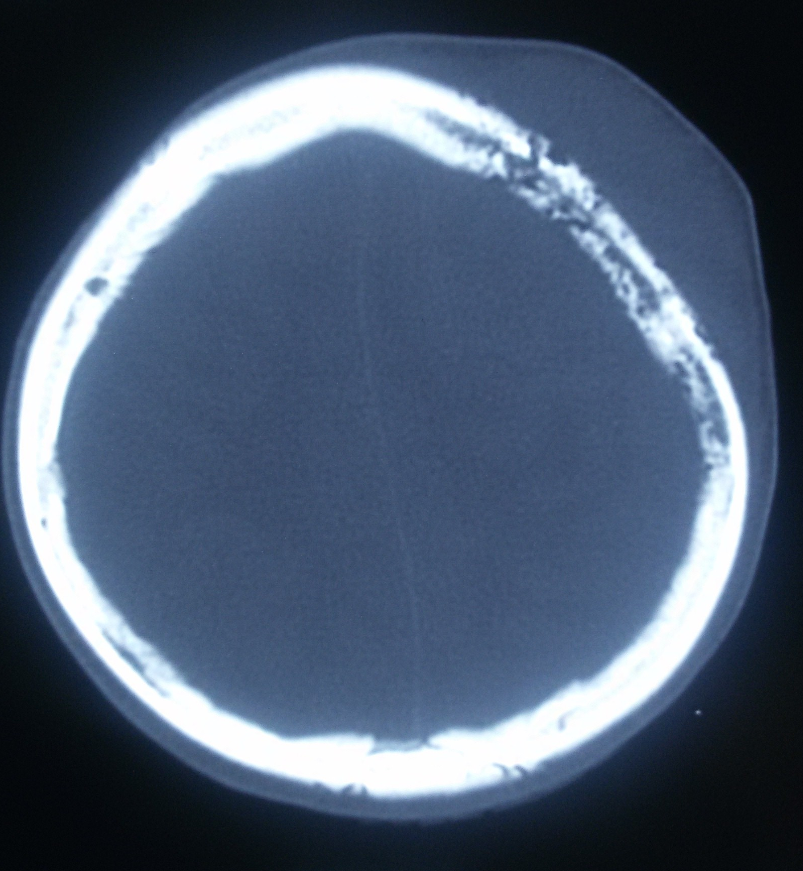 Bone metastasis from Carcinoma breast