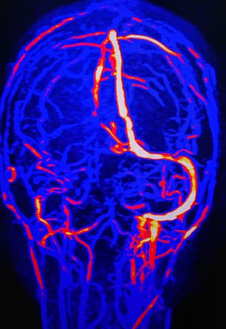 Transverse sinus thrombosis