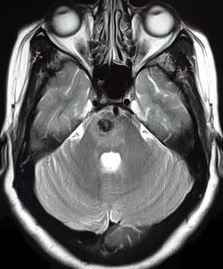 Pontine cavernoma