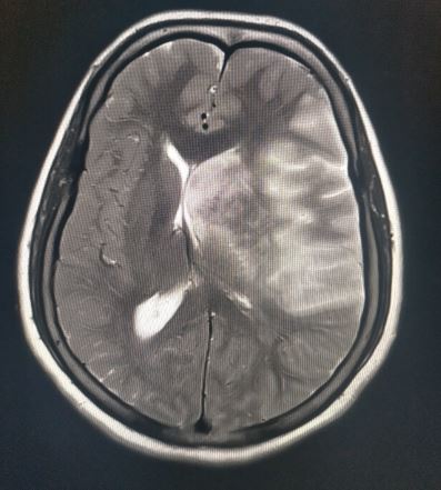 Subfalcine herniation