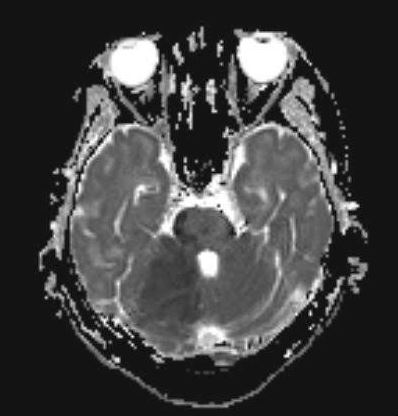 <p>MRI Finding of Cerebellar Infarction.</p>