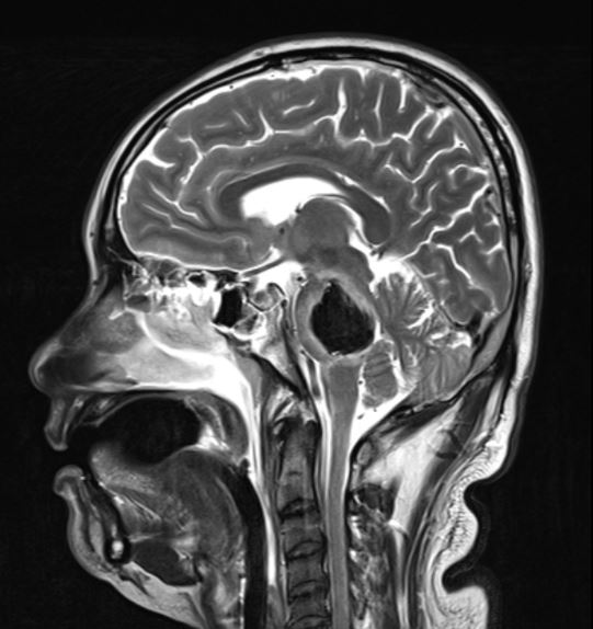 Pontine cavernoma