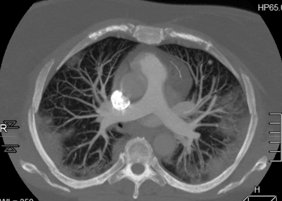 This is a sliding-thin-slab reconstruction that emphasizes areas of pneumonia, a pulmonary nodule, and blood vessels.