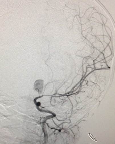 Pseudoaneurysm