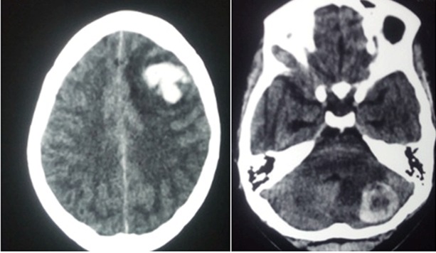 <p>Choriocarcinoma Metastasis to the Brain</p>