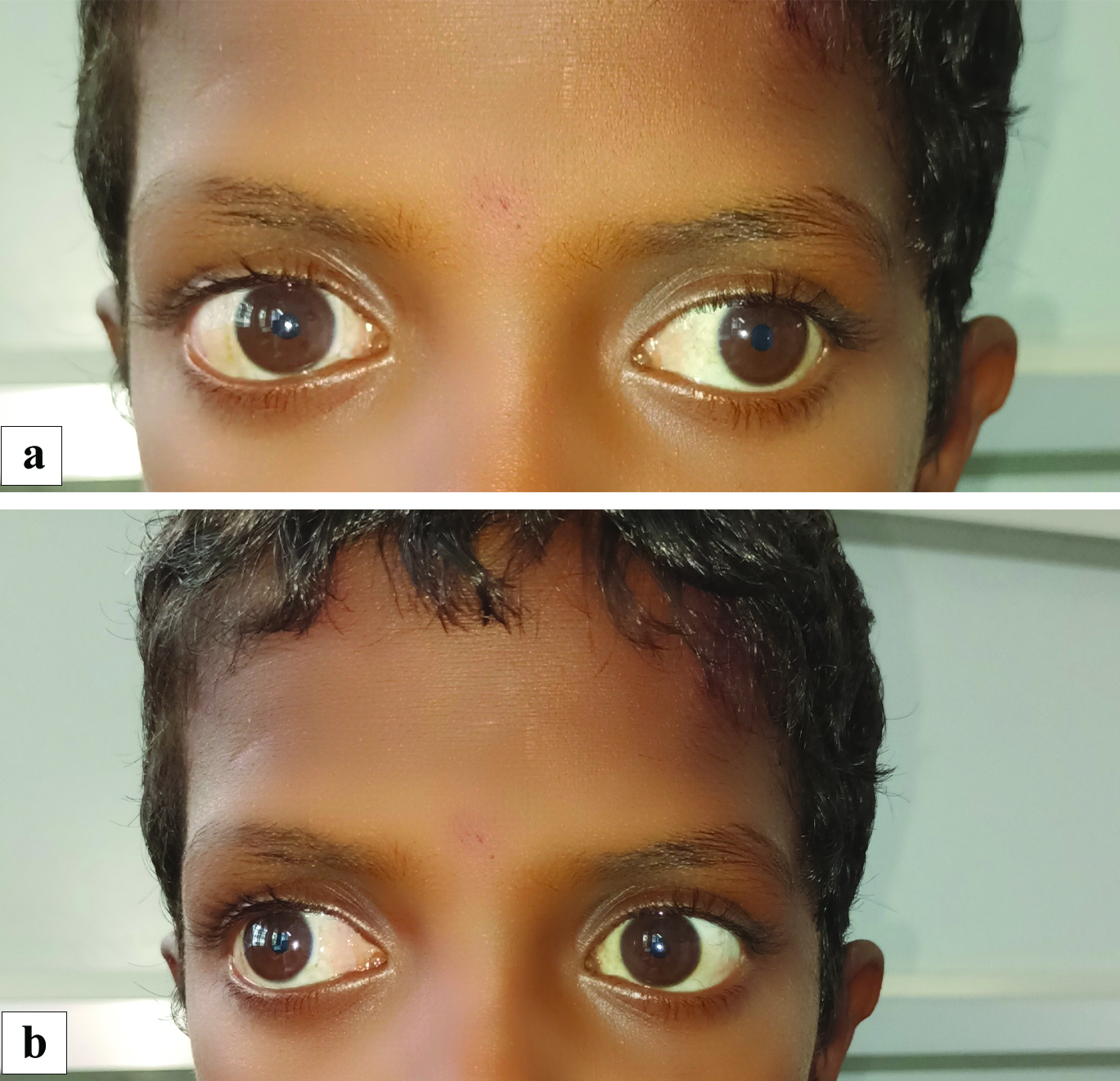 <p>Bilateral Exotropia