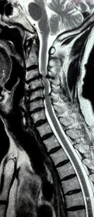 Cervical spondylosis