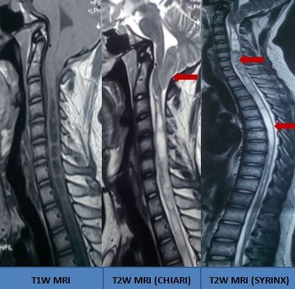 <p>Chiari Malformation With Holocord Syrinx</p>