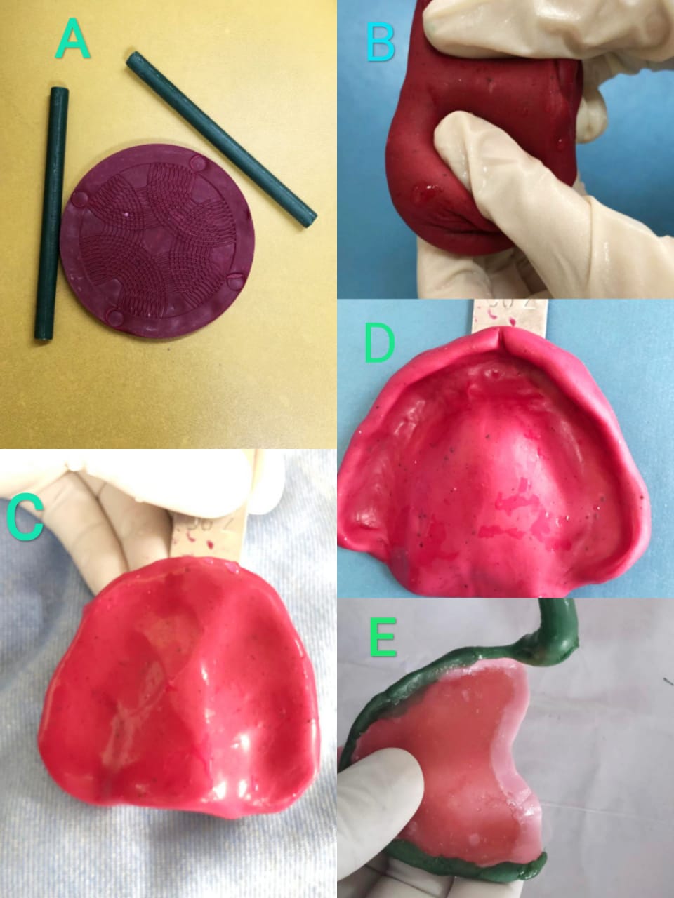 Fig1-  Impression compound
A) Cake and stick form
B) Kneading of impression compound after softening in water bath
C) Load