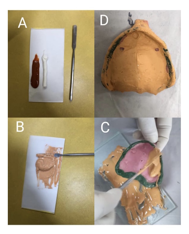 Fig2- Zinc oxide eugenol(ZOE)
A) ZOE base and catalyst dispensed on mixing pad
B) Mixing is completed confirmed by uniform 