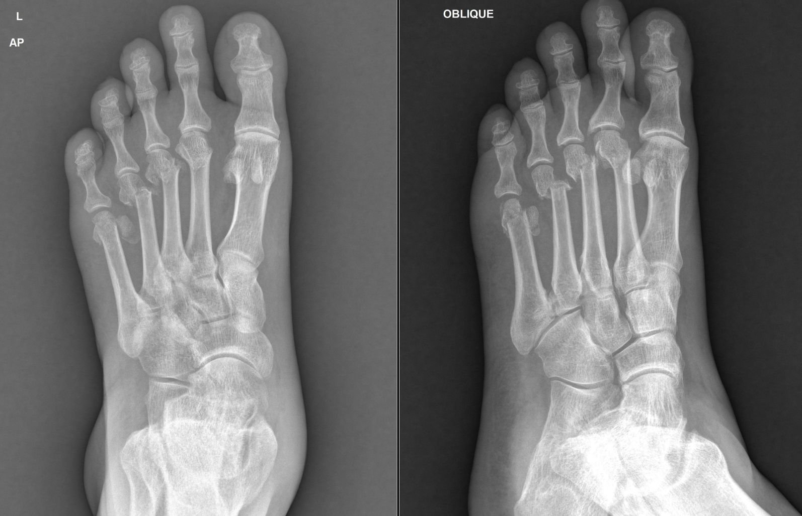 An anteroposterior and oblique x-ray of left foot showing fracture of 2nd-5th Metatarsal neck