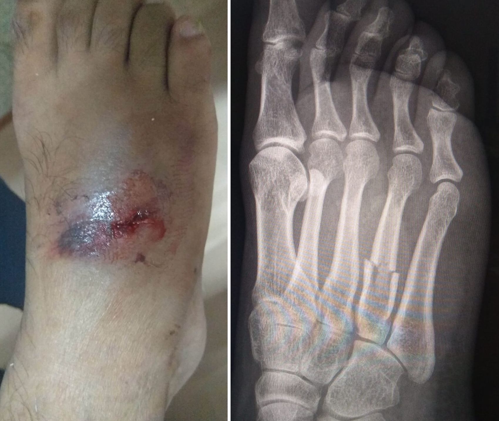 Clinical image along with an oblique view x-ray of the right foot showing open fracture of 4th metatarsal shaft